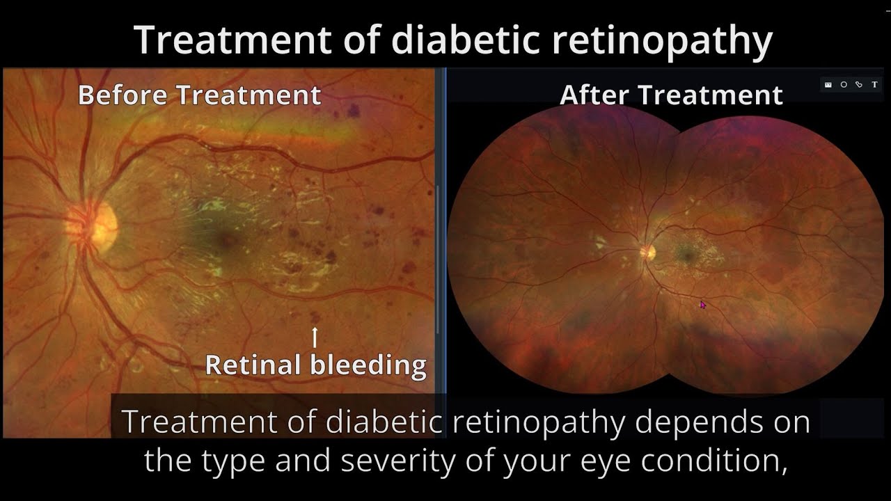 Diabetic Retinopathy Explained: Diagnosis, Symptoms & Treatments | By Sydney Ophthalmologist