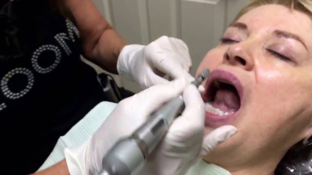 The TexasToothLady and Houston Cosmetic Dentist .. How to even out your teeth in a few minutes !