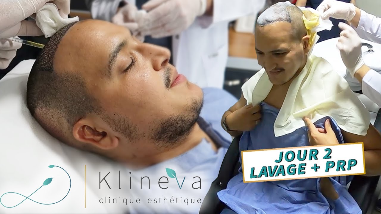 [Greffe OFFERTE] 1er LAVAGE à la clinique et traitement PRP ! 💆🏻‍♂️ 💉