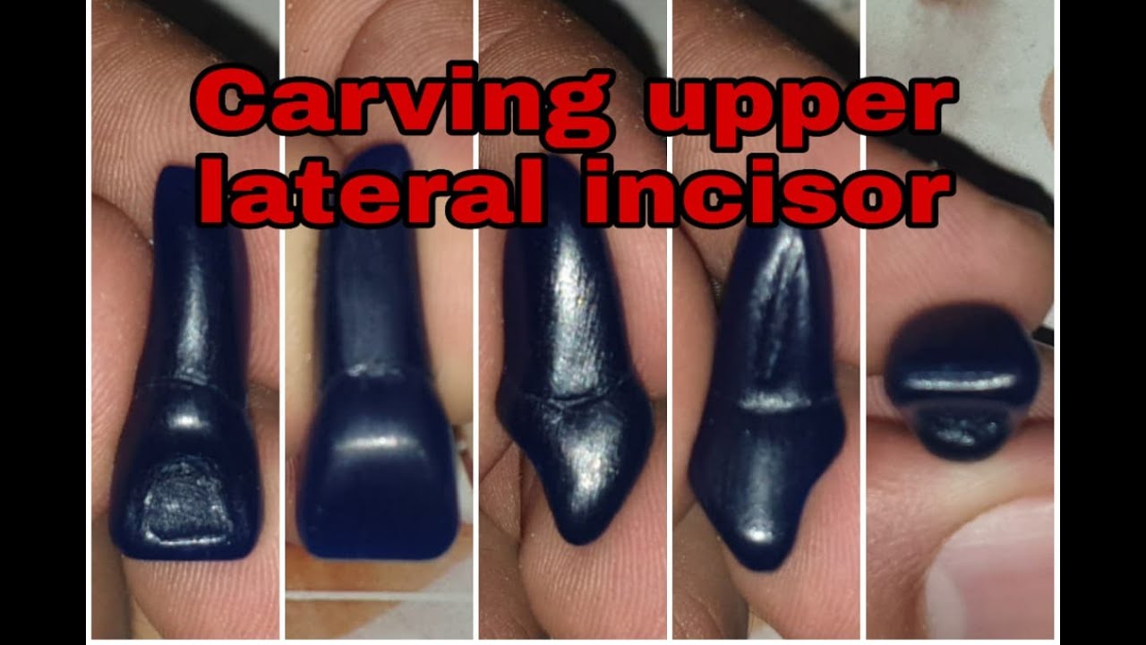 Carving upper lateral incisor  (بدون حذف مقاطع التسييح)