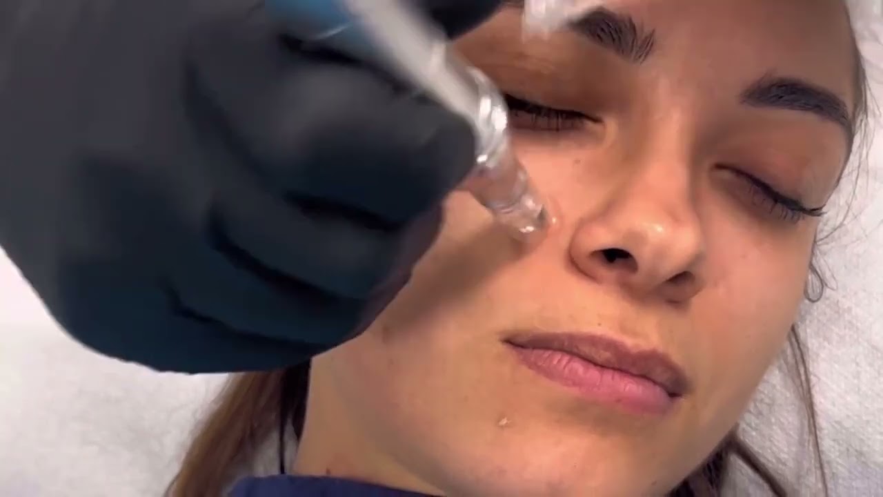 Aplicación Exosomas V Tech System de Promoitalia con dermapen / microagujas