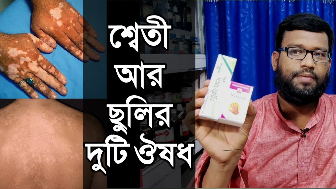 শ্বেতি ও ছুলির দুটি হোমিওপ্যাথি ঔষধ আর ক্রিম | vitiligo leucoderma Tinea versicolor homeopathy