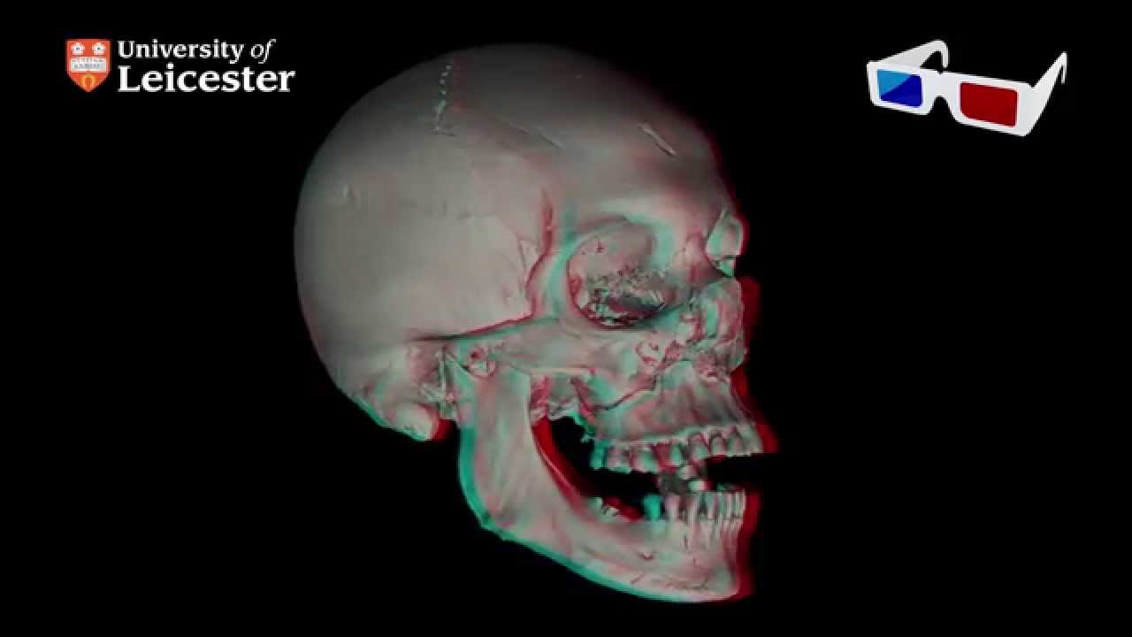 micro-CT Scan of Richard III's Skull 3D (Red - Blue 3D glasses required)