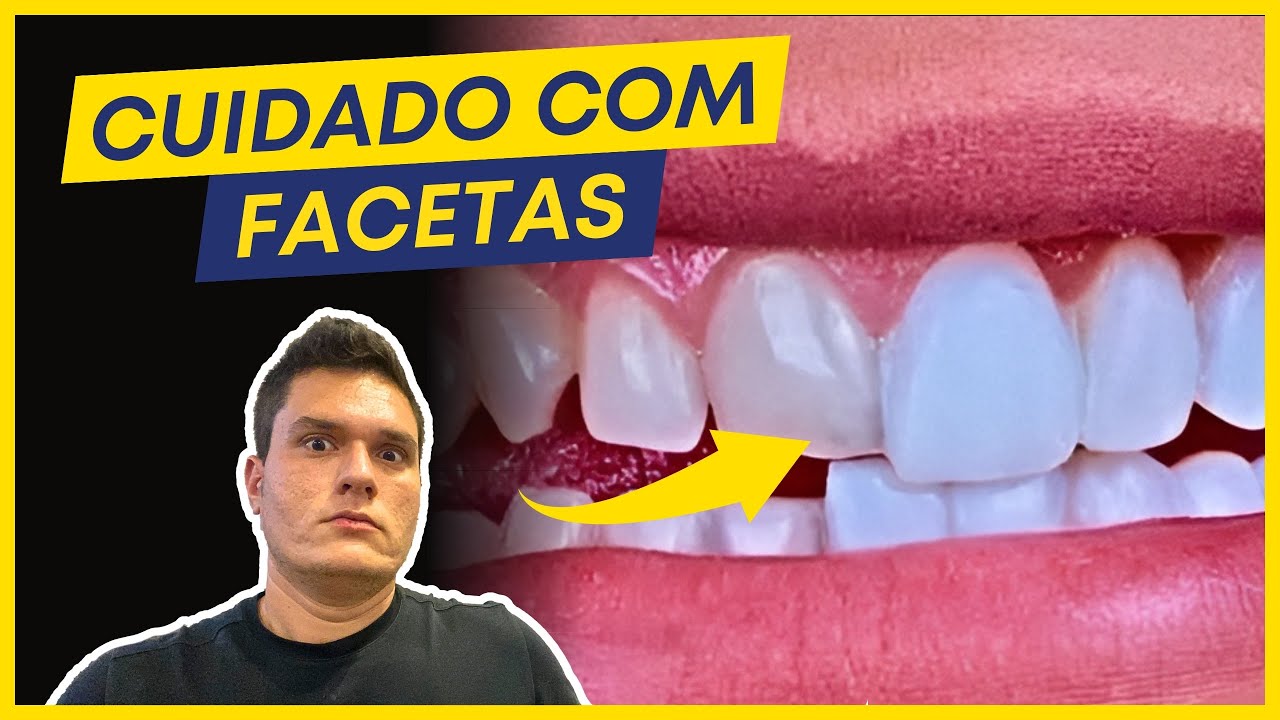 FACETAS EM RESINA : N&Atilde;O FA&Ccedil;A antes de ver ESSE v&iacute;deo!