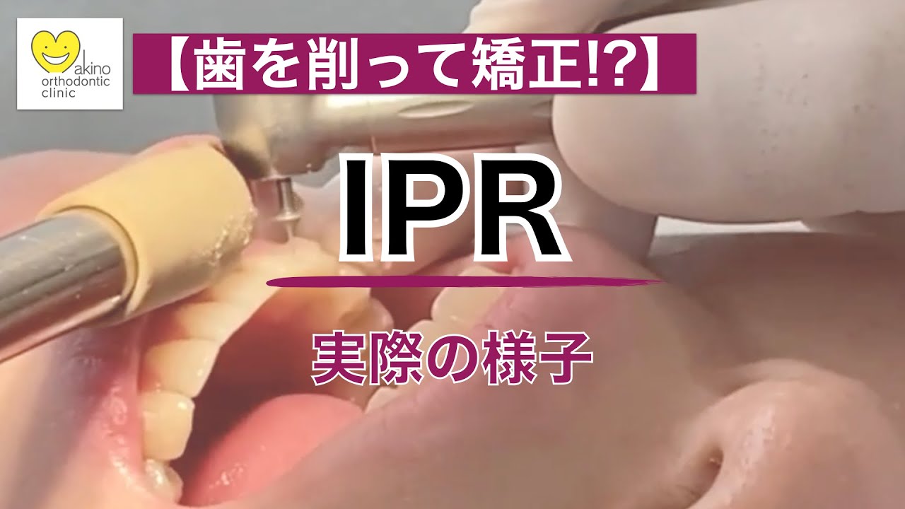 【映像】矯正で歯を削る!?【IPR】とは？ストリッピング・ディスキング【千葉県船橋近くの矯正歯科専門医】