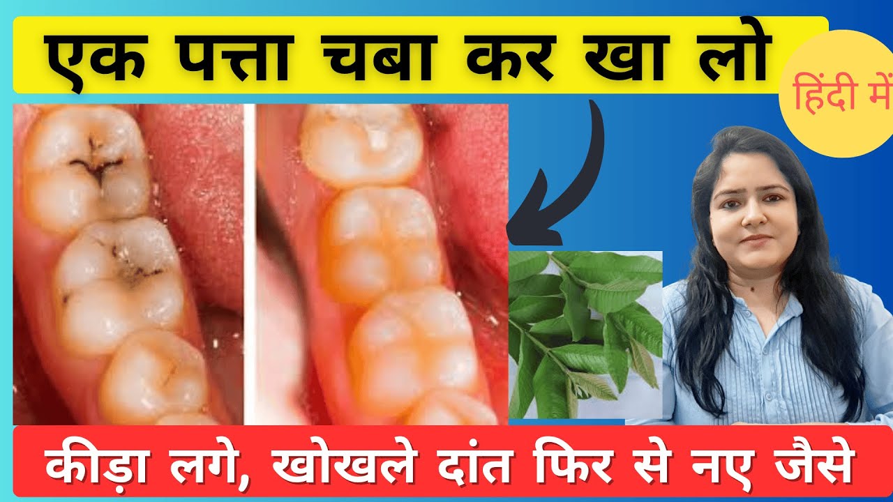 दांतों में दर्द और कीड़े का इलाज Treatment of tooth decay#cavity