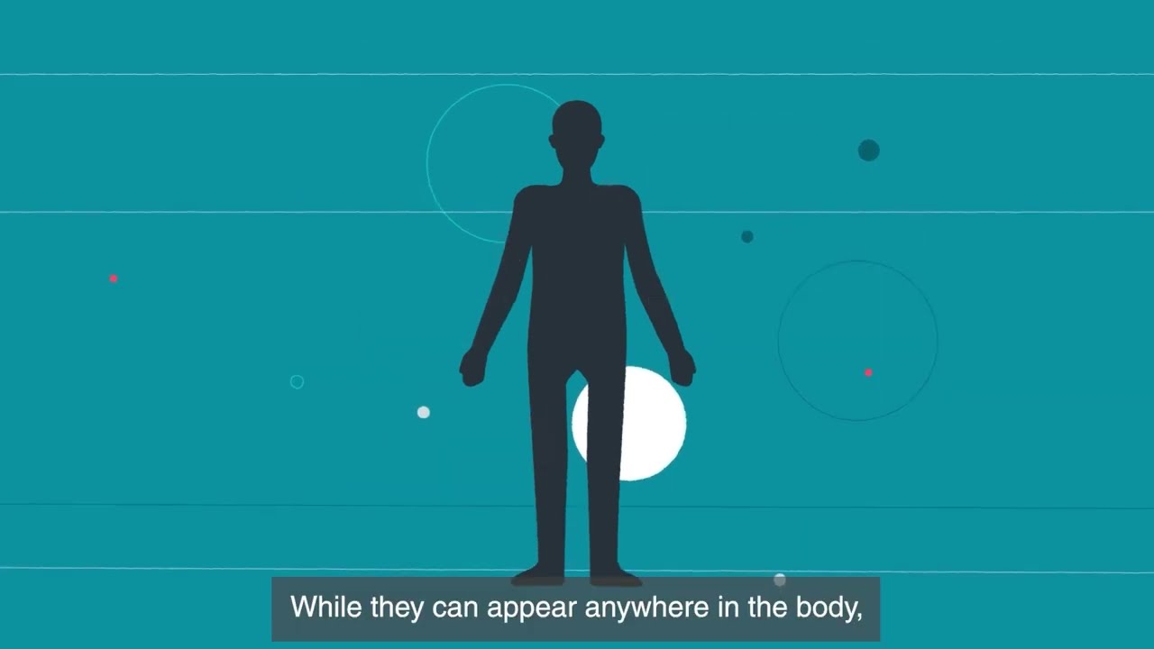 Sarcoma - Medical student education animation