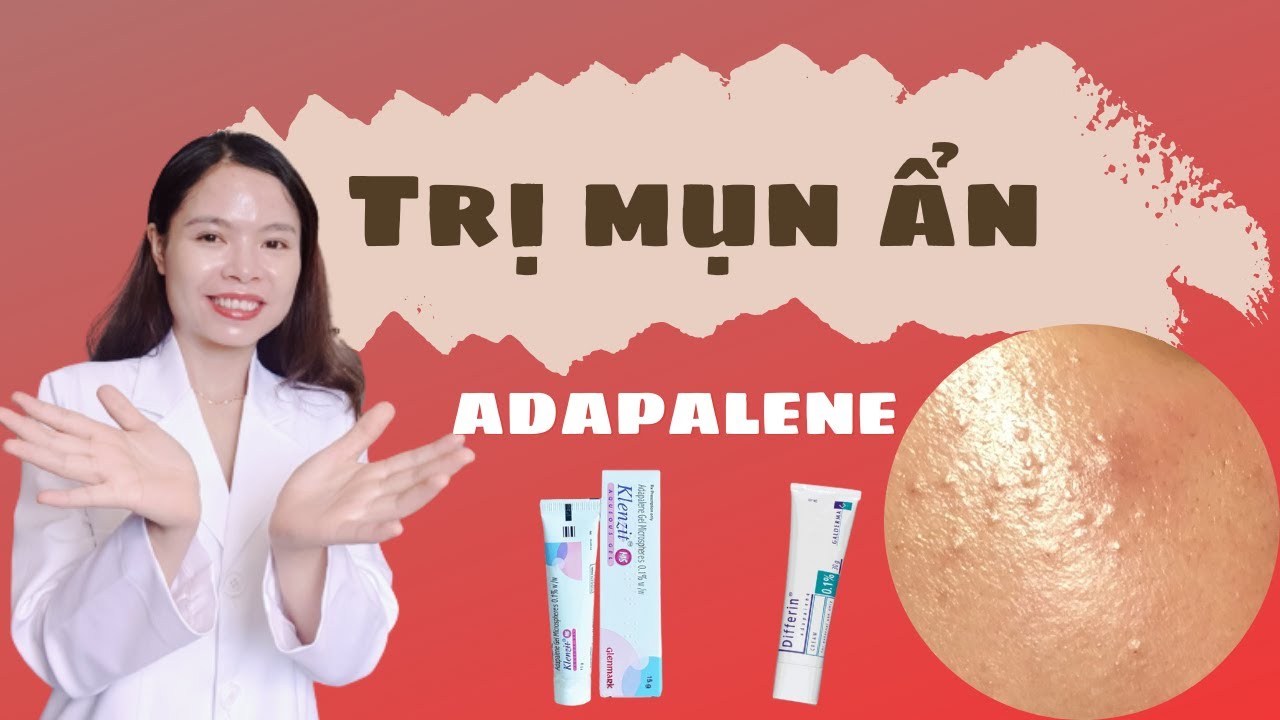 Mụn ẩn là gì ? adapalene là gì ? Cách sử dụng adapalene để trị mụn ẩn dưới da tại nhà.