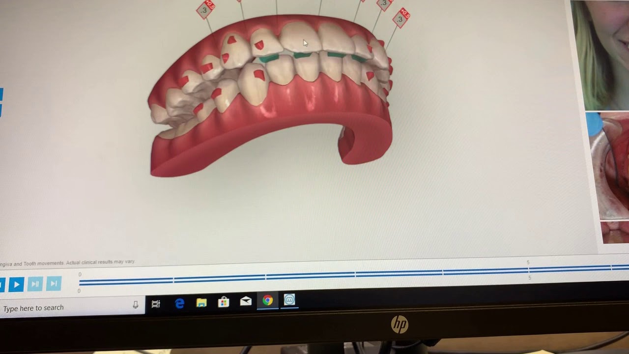 Class II Subdivision and Excess of Overjet correction - Houston & Pearland Orthodontist