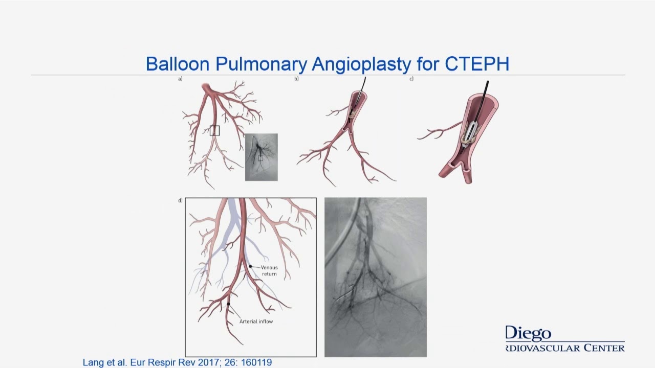 Interventional Treatment of Chronic Thromboembolic Pulmonary Hypertension - Ehtisham Mahmud, MD