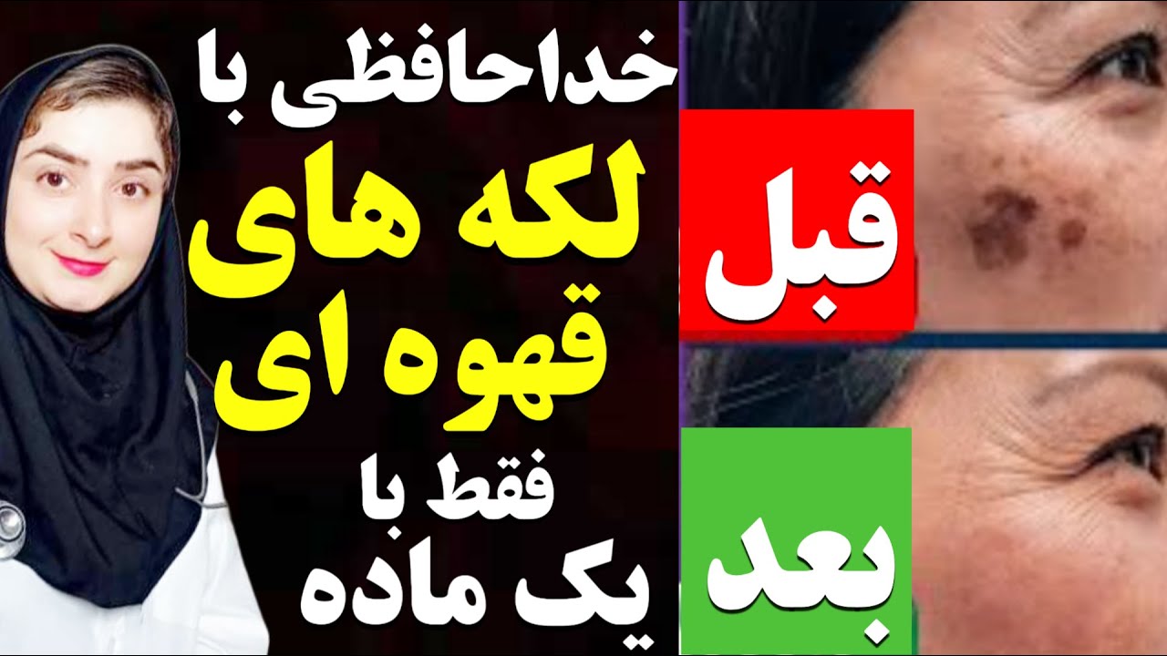 درمان همیشگی لکه های قهوه ای پوست و لکه های پیری ‌روی صورت،گردن و بدن فقط با یک ماده معدنی