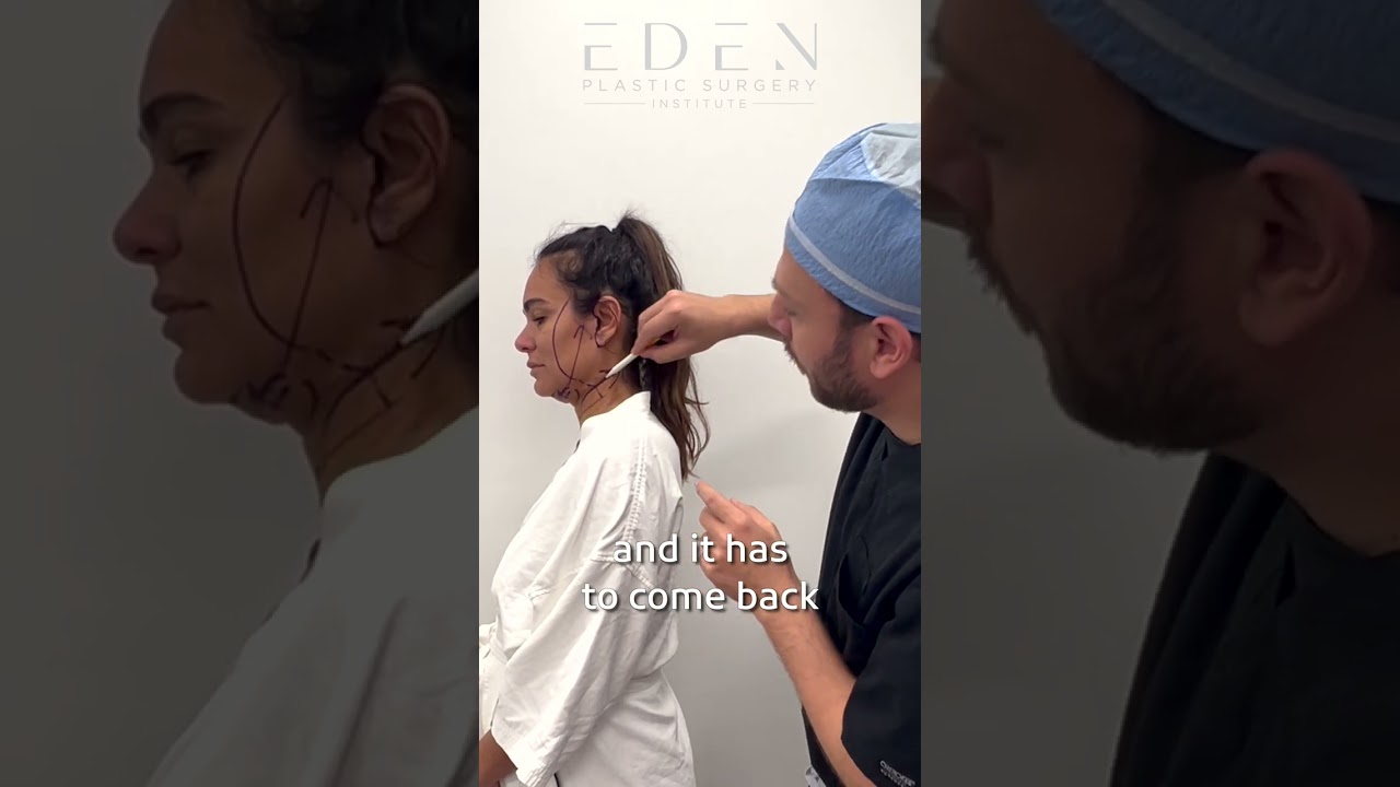 EVE Lift™️Facelift, Neck Lift | Eden Plastic Surgery: Ali Charafeddine, MD