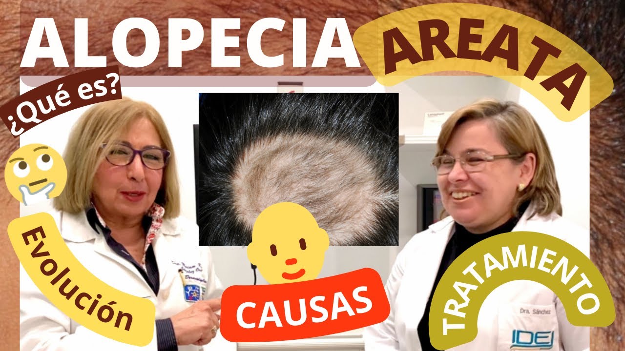 ALOPECIA AREATA. ¿QUÉ ES? CAUSAS, EVOLUCIÓN Y TRATAMIENTO. @depielapiel