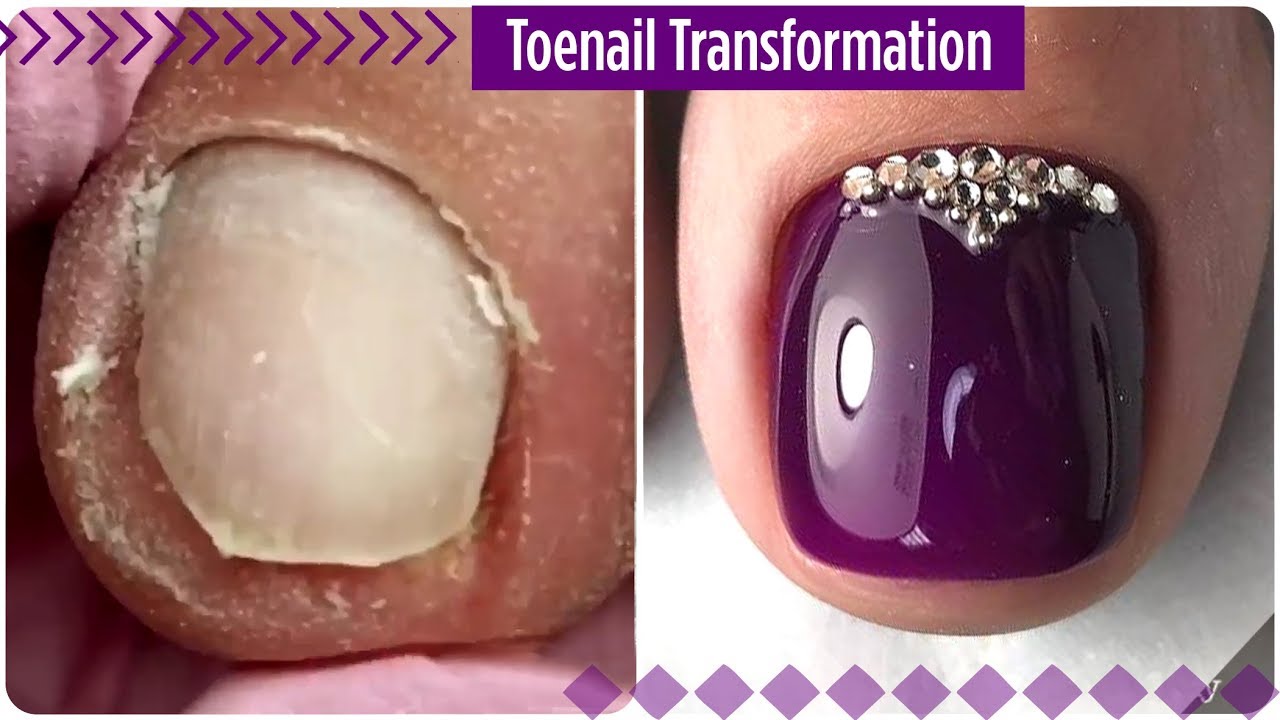 Amazing Toenail Transformation 💗 Toenail pedicure