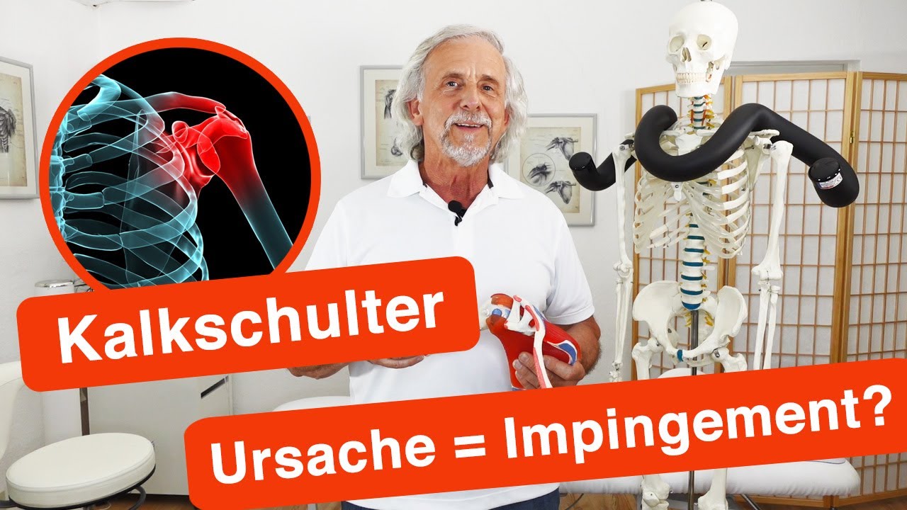 Nie mehr Kalkschulter! Die erstaunliche L&ouml;sung bei Schulterschmerzen ✅