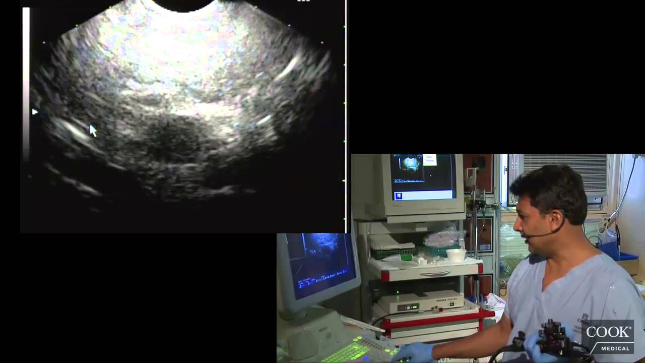 Mediastinal Mass vs Cyst - Dr. Anand Sahai MD