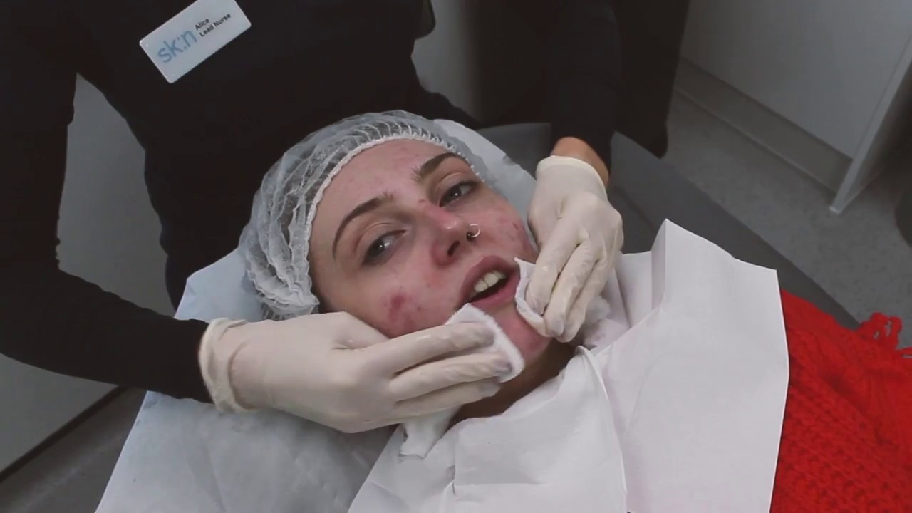 My Chemical Peel at SK:N Harley Street for Acne