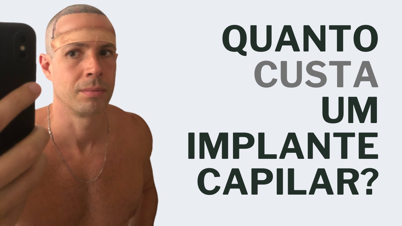 QUANTO CUSTA UM IMPLANTE CAPILAR? Veja como eu fiz orçamentos! | Finanças Pessoais - Daniel Souza