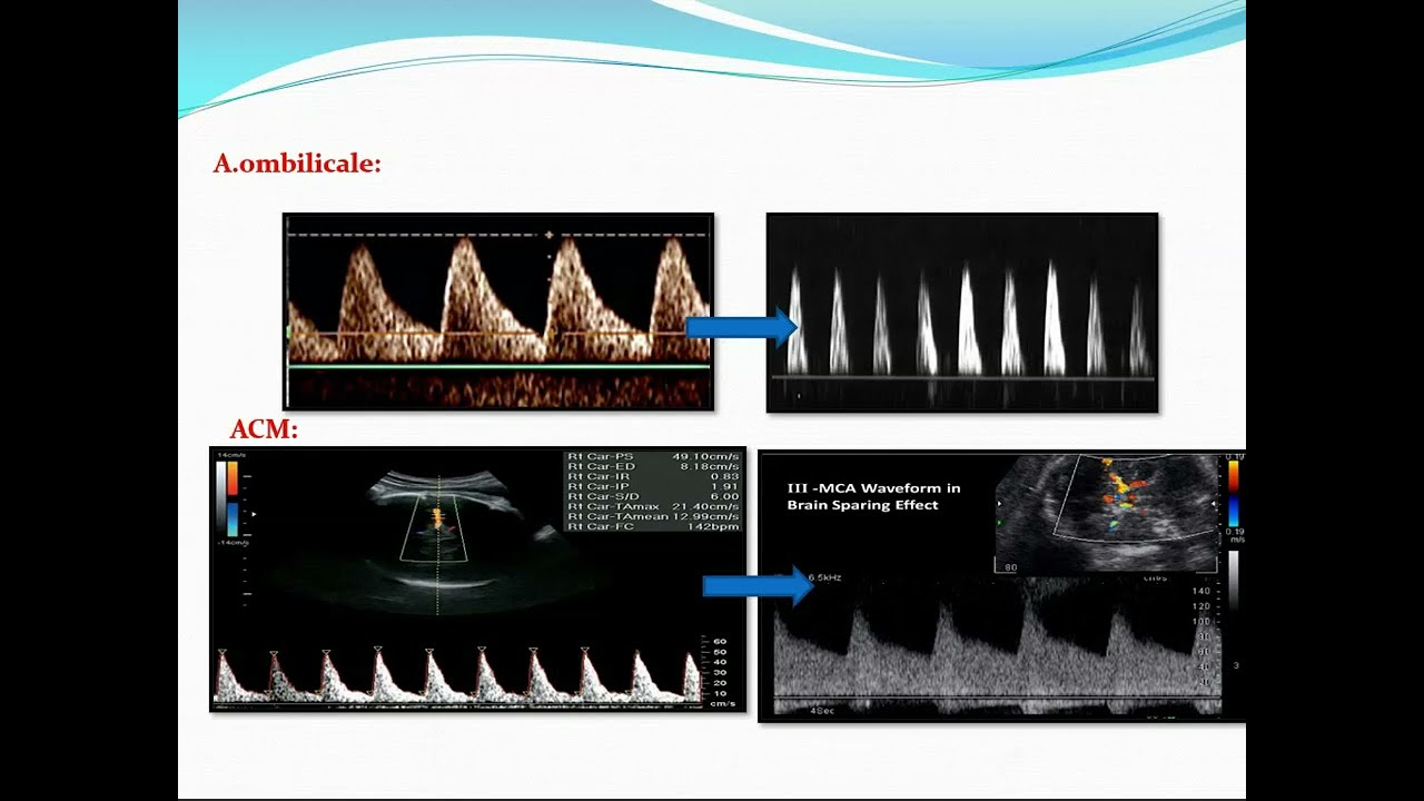 Doppler Obstétrical