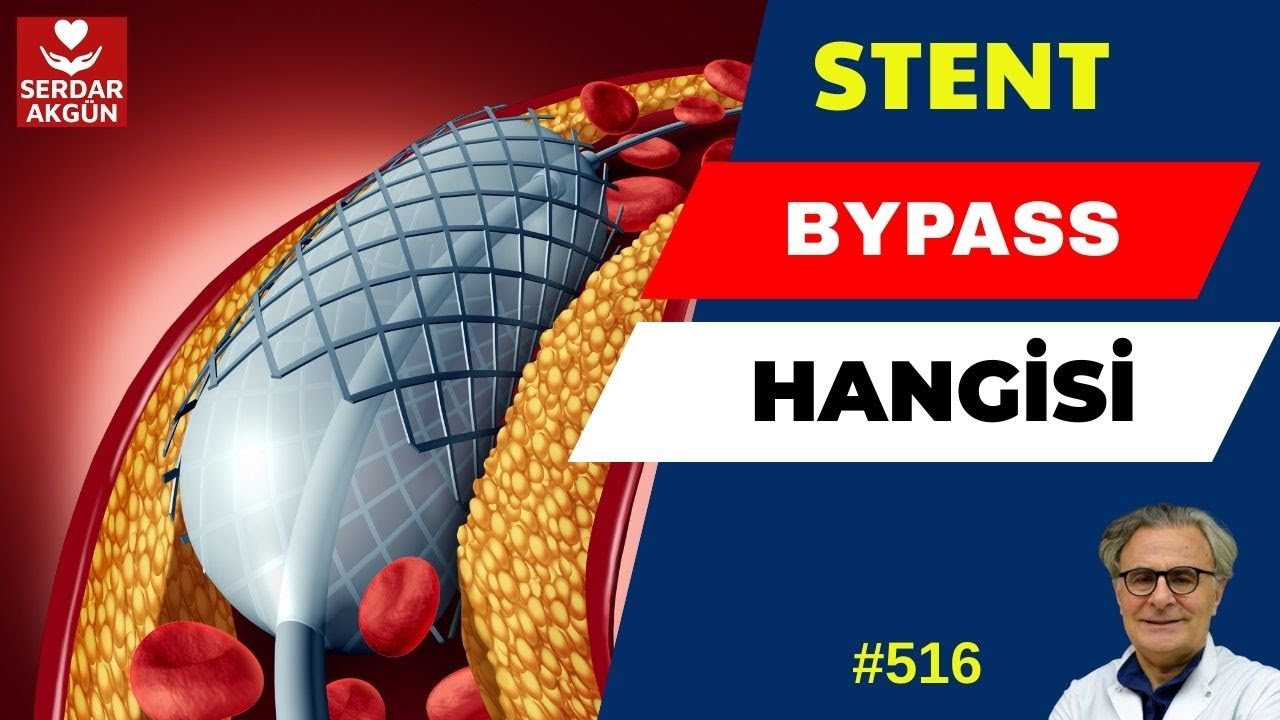 516. STENT Mİ? BYPASS MI? SAĞLIK VİDEOLARI, SERDAR AKGÜN  kalp damar cerrahisi damar sertliği sağlık