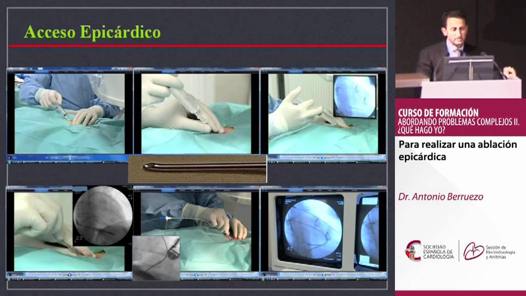 Para realizar una ablaci&oacute;n epic&aacute;rdica. Dr. Antonio Berruezo.