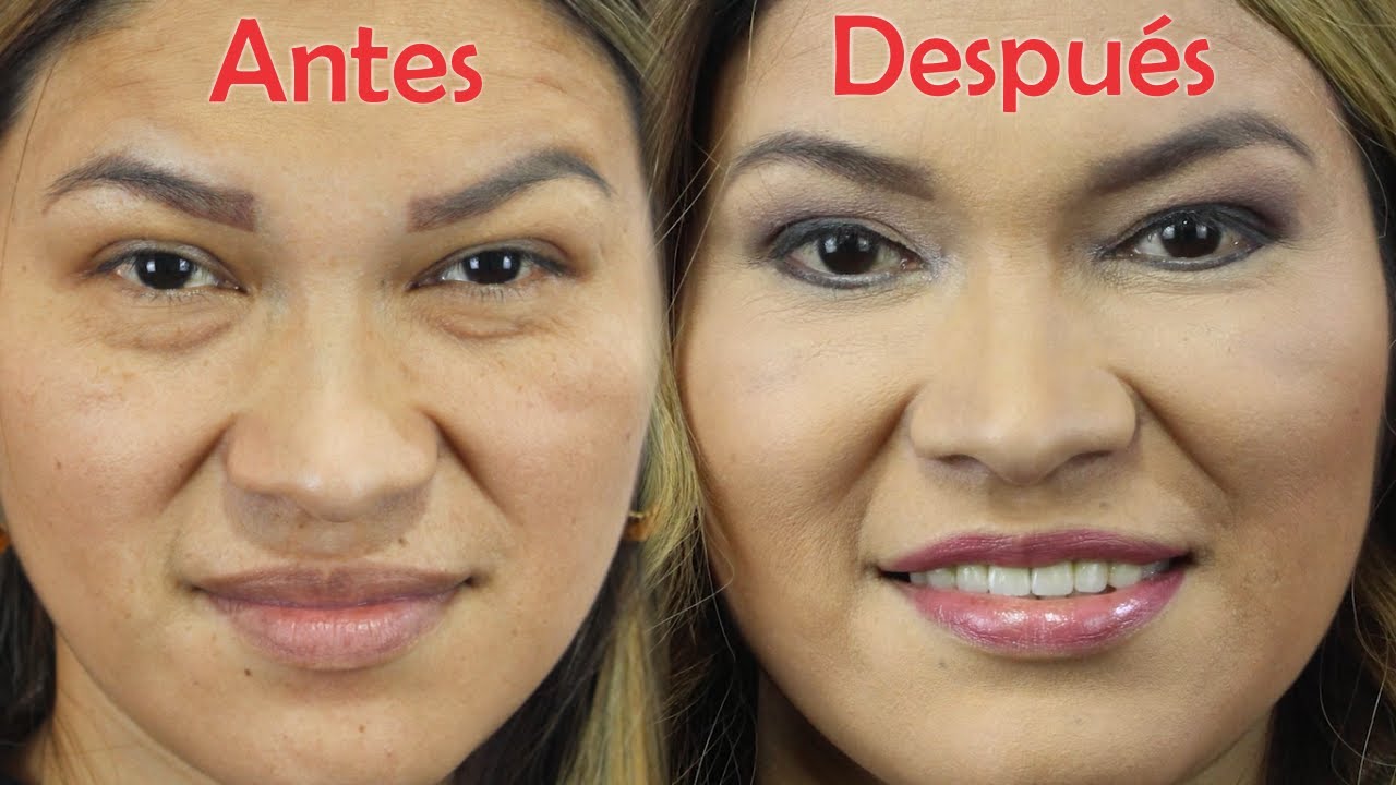 IMPRESIONANTE CAMBIO ❤️ Blefaroplastía y Lipoinjerto 👀 Ojos BONITOS 🤩 DR PERCY NEVADO