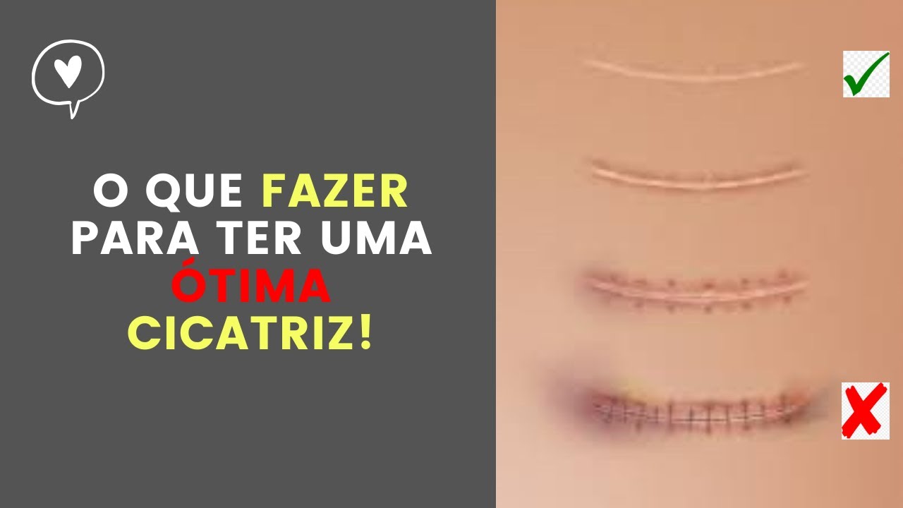 O que fazer para ter uma ótima cicatriz!