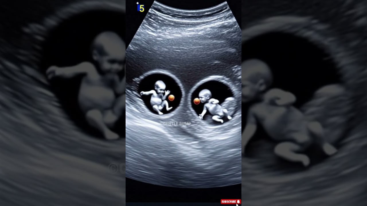 Incredible Ultrasound: A Glimpse of Twin Babies Growing Inside the Womb