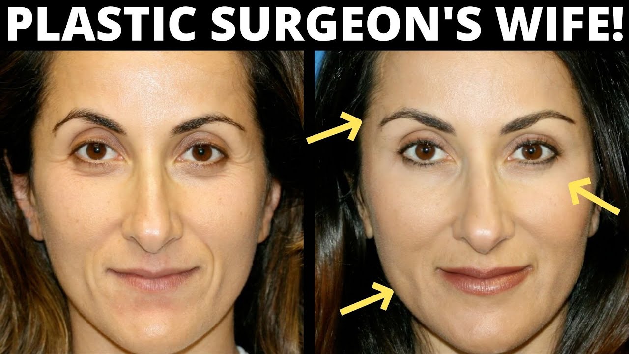 Facial Fat Transfer Before & After: Look 10 Years Younger with Facial Fat Transfer