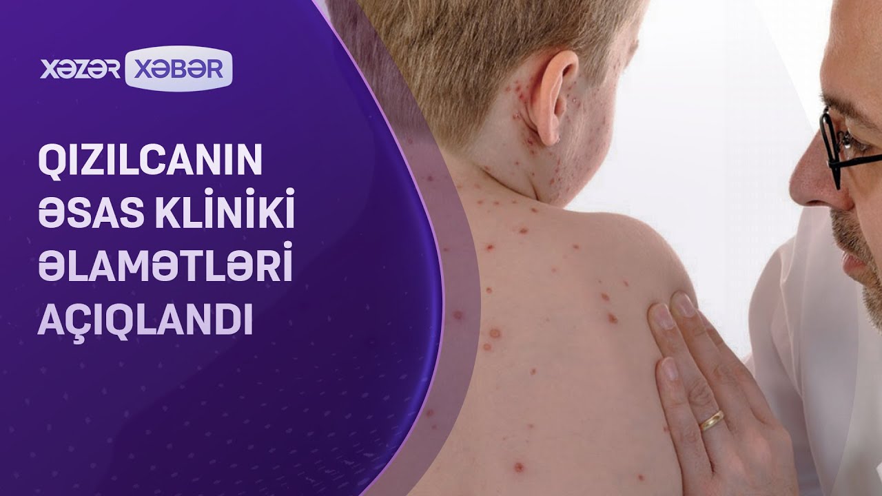 Qızılcanın əsas kliniki əlamətləri AÇIQLANDI