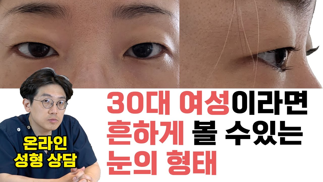 이런 눈을 가지셨다면 보세요 - 30대 여성이 고민하는 부분 /돌출안,함몰눈,쌍수,눈매교정,눈지방,