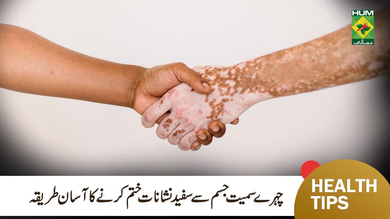 Treatment of Bars Vitiligo Leucoderma | Skin ke White Spots ka Ilaj | Hakeem Shah Nazir | MasalaTV