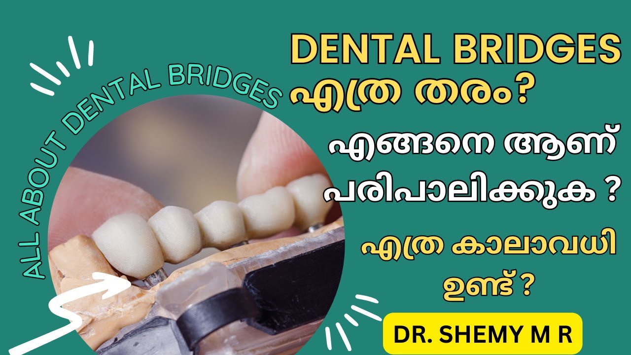ഡെന്റല്‍ ബ്രിഡ്ജ്  ഏതെല്ലാം? Types of dental bridges (Malayalam)|| എങ്ങനെയാണ് പരിപാലിക്കുക? Dr Shemy