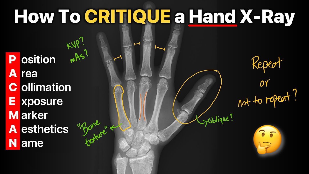 How to Critique a Hand X-Ray!