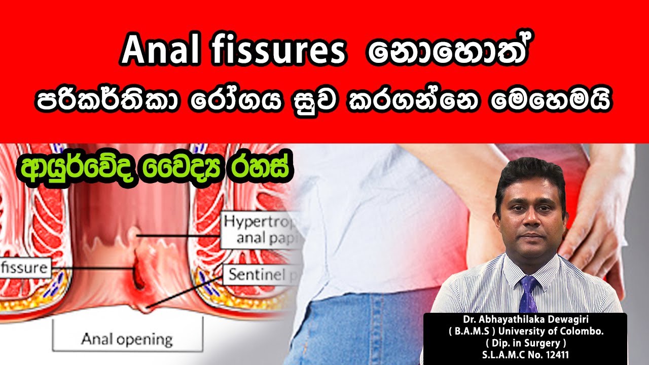 Anal fissures  | පරිකර්තිකා  රෝගයට නොවරදින ආර්යුවේද පිළියම්  | Dr.Abhayathilaka Dewagiri
