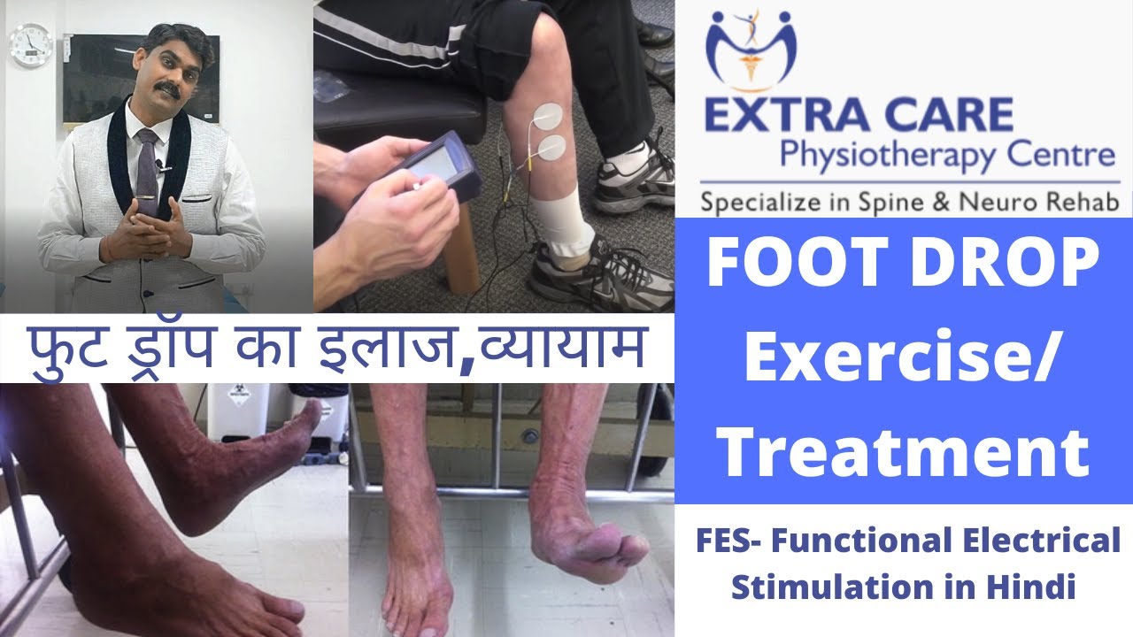 Foot Drop Treatment and Exercise Through FES | Functional Electrical Stimulation in Hindi