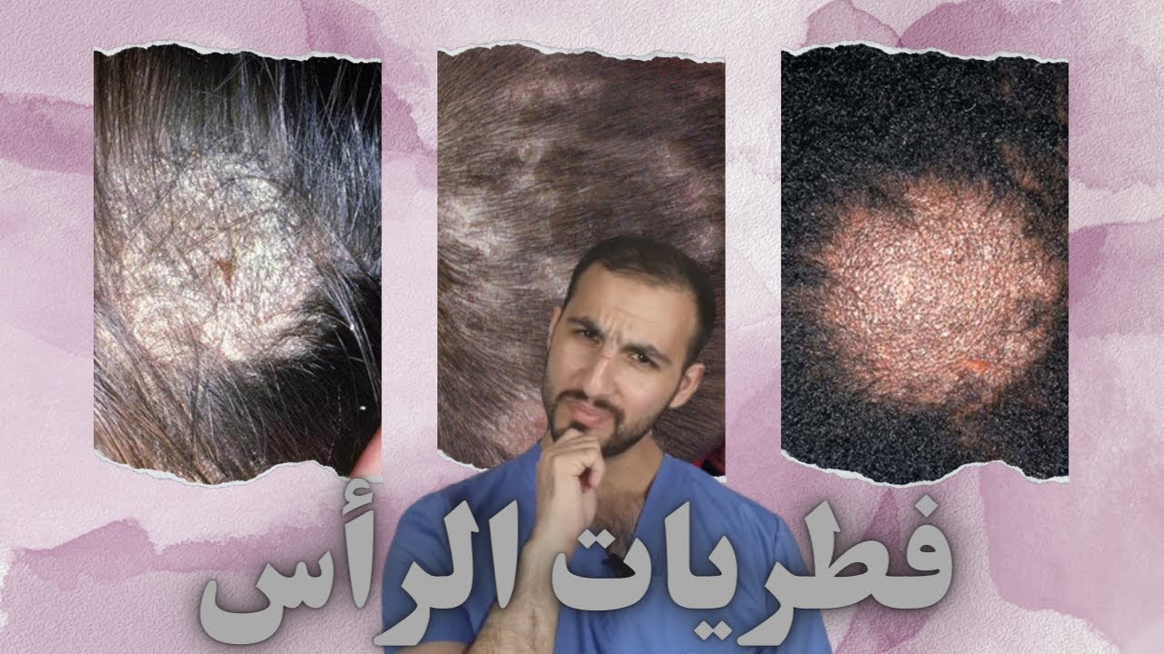 فطريات الرأس (الأسباب و الأعراض و العلاج)