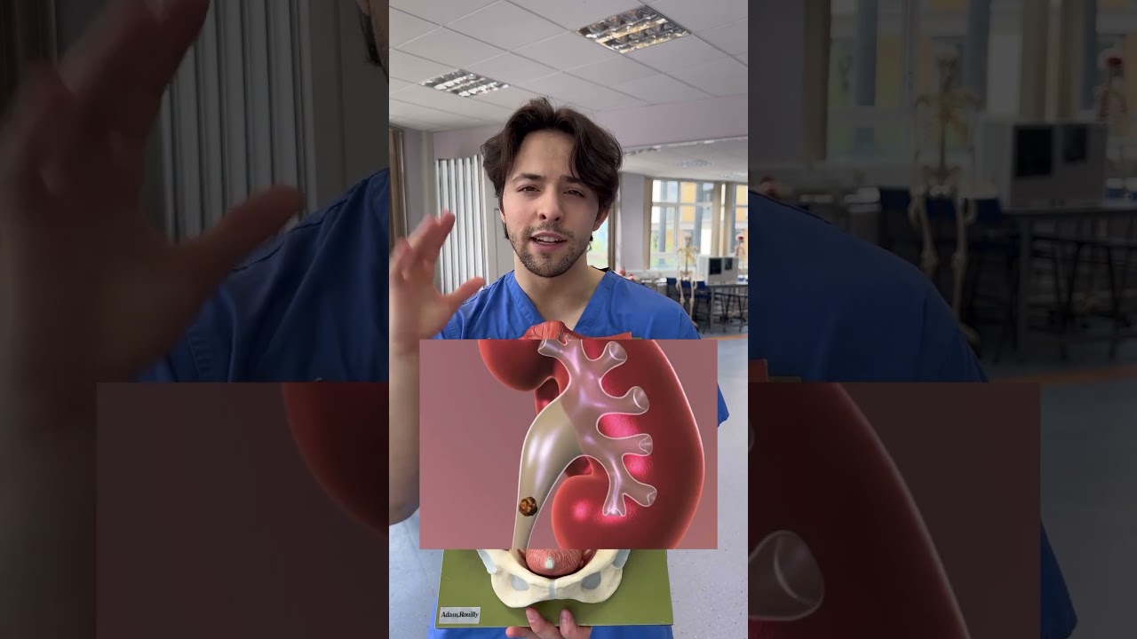 EVIL STONES IN YOUR KIDNEY 💔🥲 #medicine #premedstudent #premed #learn #doctor