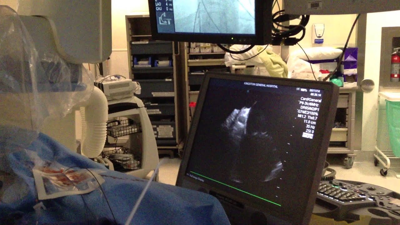 7 PVI - Intracardiac echo
