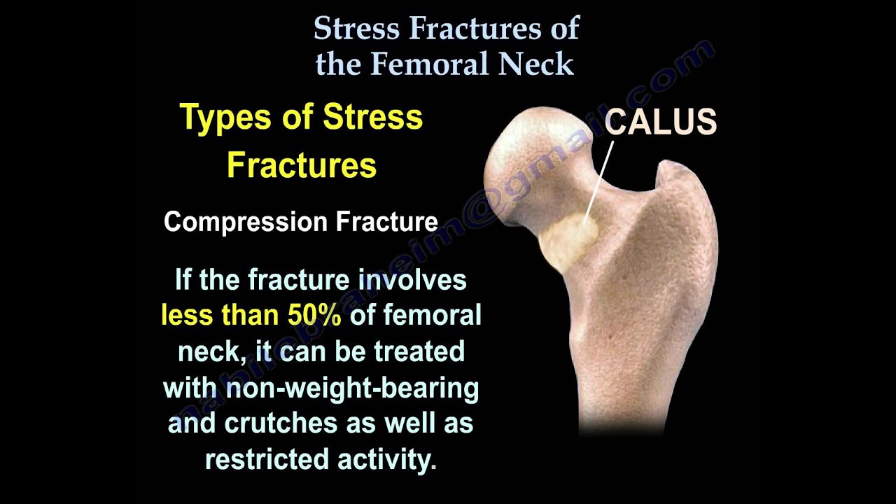 Stress Fractures Of The Femoral Neck - Everything You Need To Know - Dr. Nabil Ebraheim