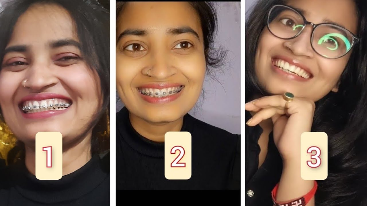 7months after braces😁/final look after braces/detailed video/cost+location+sideeffect#teeth #braces