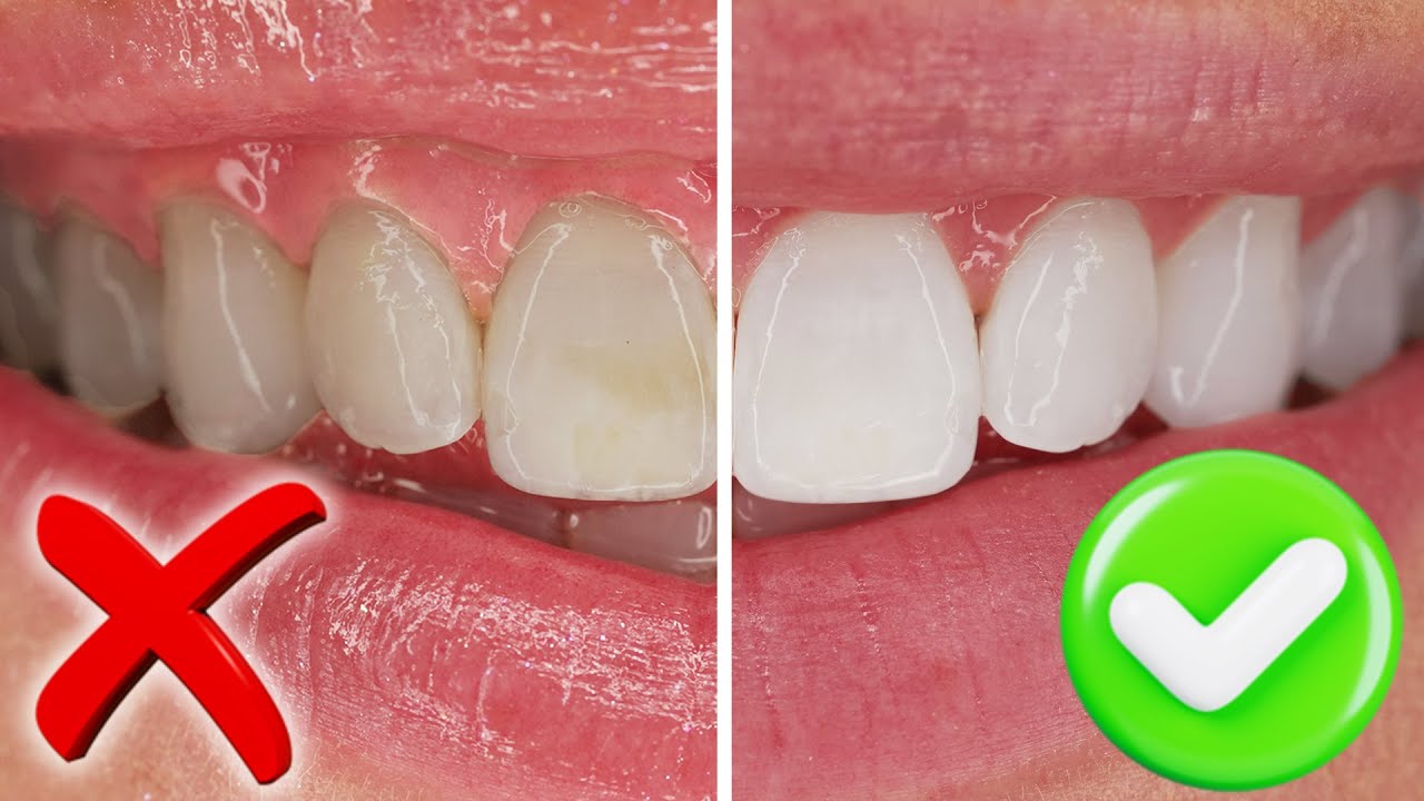 Стоматолог рассказывает, как отбелить зубы УЛЬТРА БЕЛЫЕ И БЫСТРО, как они окрашиваются и почему о...