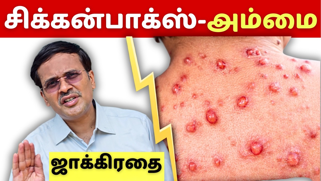 அம்மை வேகமாக தமிழகத்தில் பரவுகிறது! குளிக்கலாமா? வேப்பஇலை? சாப்பாடு? chicken pox in tamil