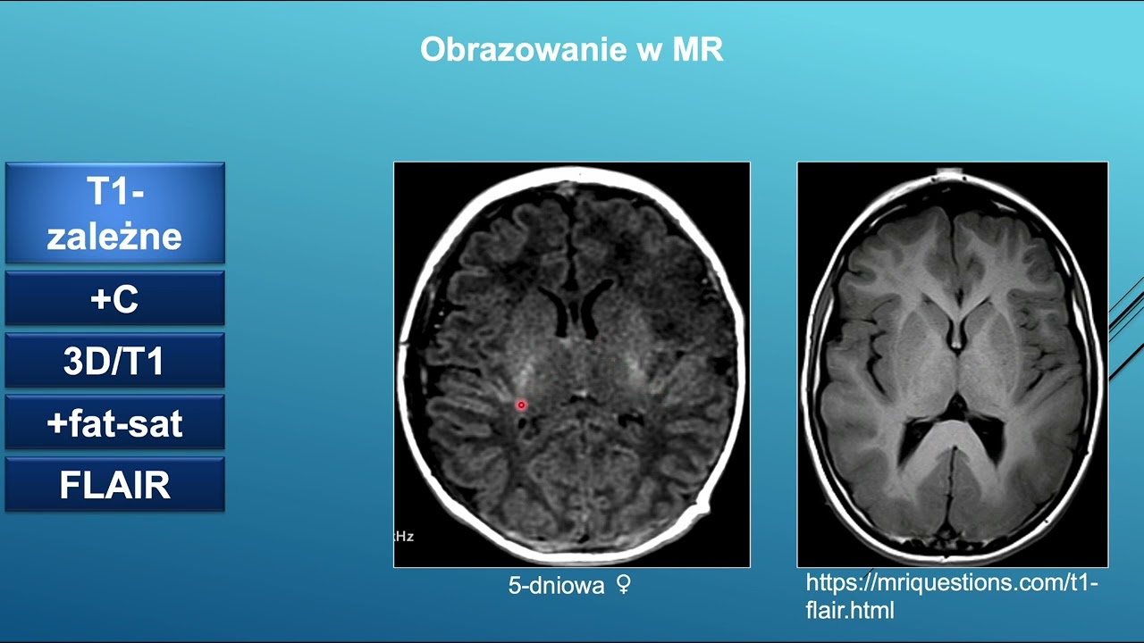 A. Duczkowska - “Mapa drogowa w neuroradiologii” (przegląd sekwencji MR i ich zastosowanie)