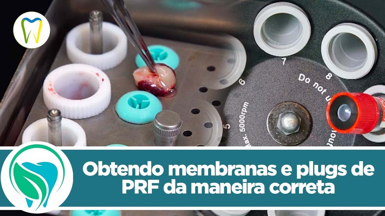 Obtendo membranas e plugs de PRF da maneira correta