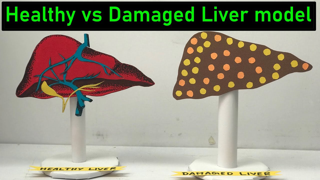 Healthy Liver vs Damaged Liver model (Cirrhosis) | Health Awareness Liver Model | #diyasfunplay