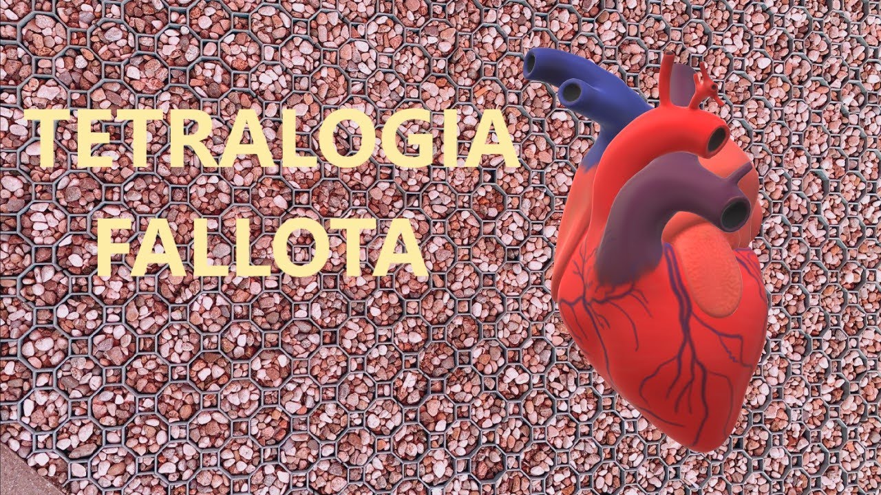 TETRALOGIA FALLOTA - złożona wada serca
