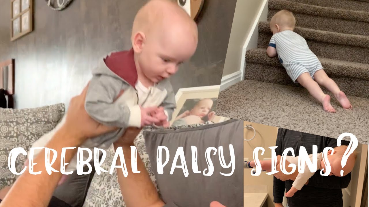 Does He Have Cerebral Palsy? Hypertonia? || Sagittal Craniosynostosis issues