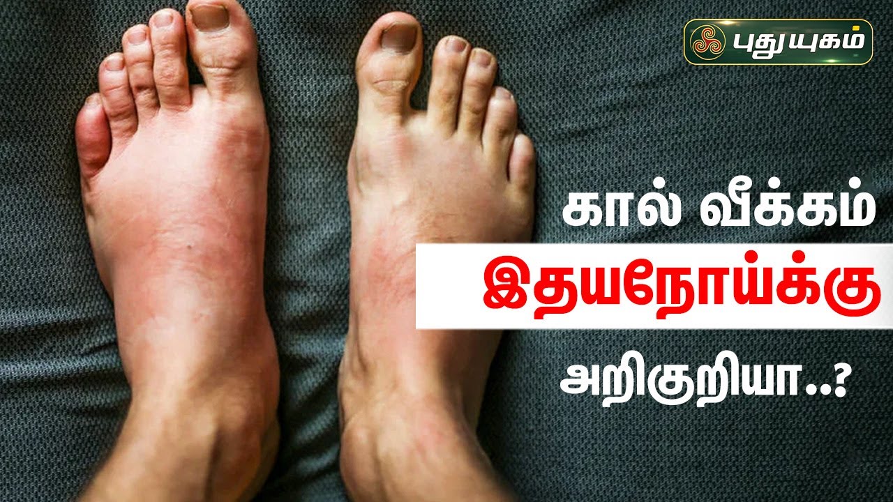 கால் வீக்கம் இதயநோய்க்கு அறிகுறியா..? | Dr.Jayaroopa | Iniyavai Indru | PuthuyugamTV