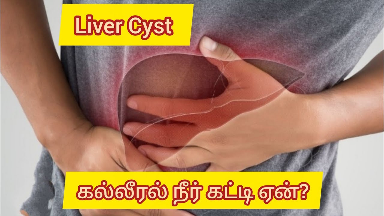 Liver cyst.கல்லீரல் நீர் கட்டி. Homoeopathy Treatment 